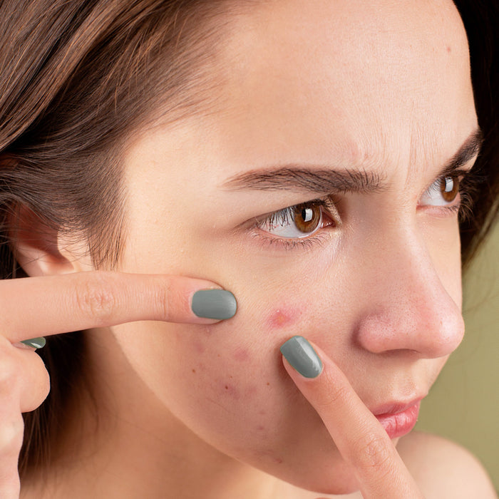 How to Reduce Breakouts with a Proper Skincare Routine